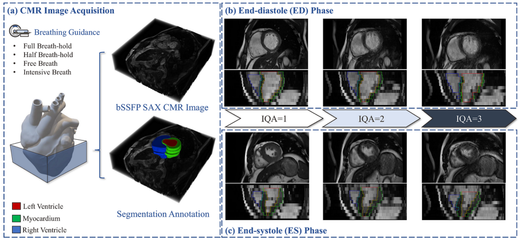 Extreme Cardiac MRI Analysis under Respiratory Motion: Results of the CMRxMotion Challenge